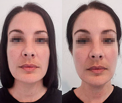 Lymvita™ Flüssige Lymphdrainage – Verfeinertes Gesicht, leichte Beine, flacher Bauch